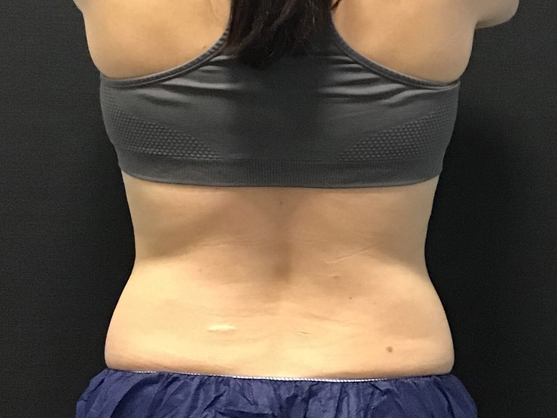 CoolSculpting Before & After Image
