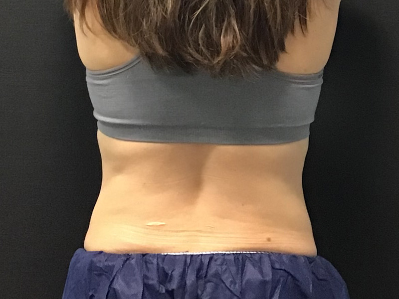 CoolSculpting Before & After Image