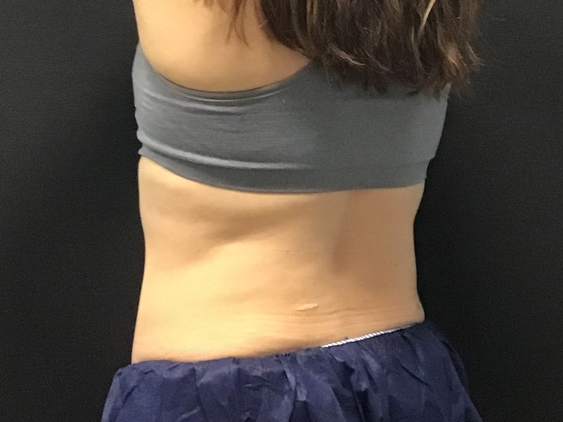 CoolSculpting Before & After Image