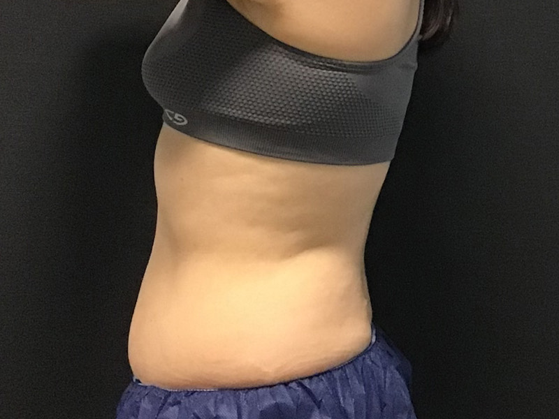 CoolSculpting Before & After Image