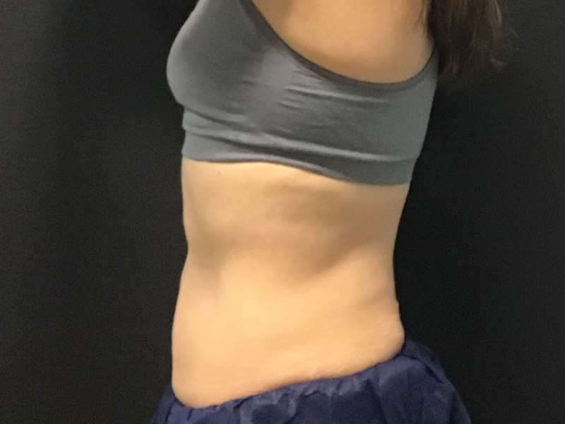 CoolSculpting Before & After Image