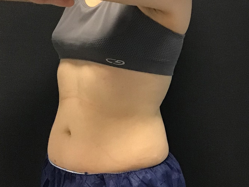 CoolSculpting Before & After Image