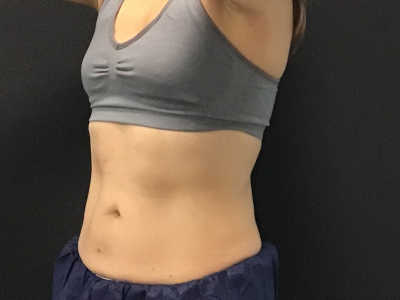 CoolSculpting Before & After Image