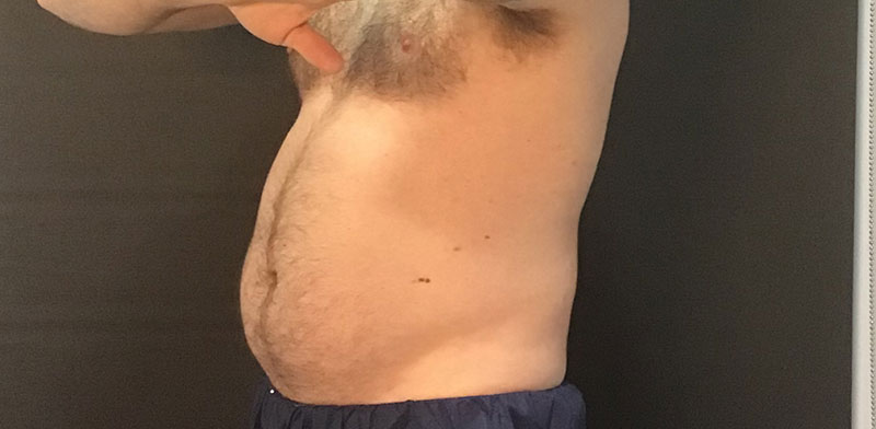 CoolSculpting Before & After Image