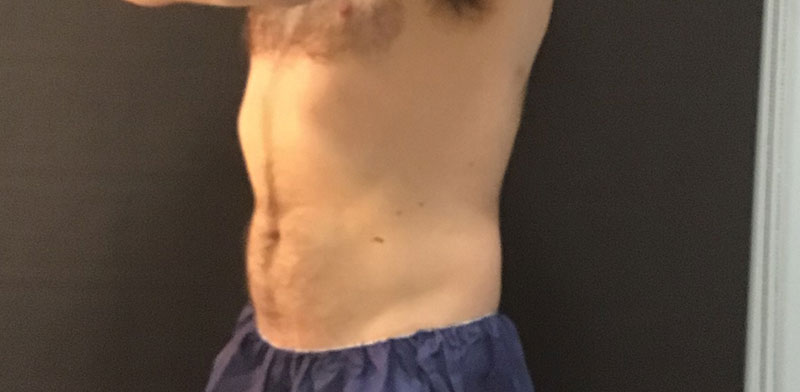 CoolSculpting Before & After Image