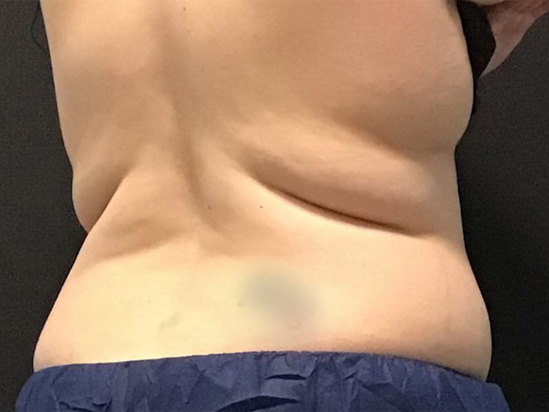 CoolSculpting Before & After Image