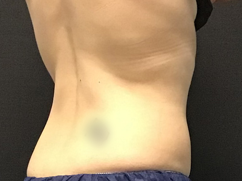 CoolSculpting Before & After Image