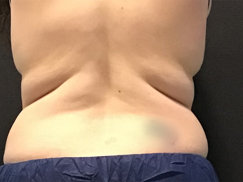 CoolSculpting Before & After Image