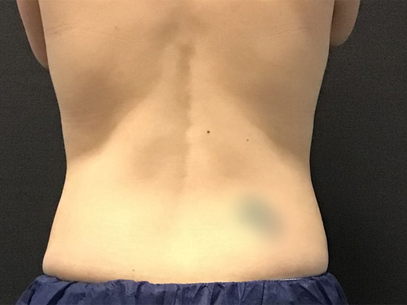 CoolSculpting Before & After Image