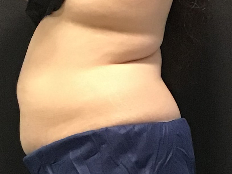 CoolSculpting Before & After Image