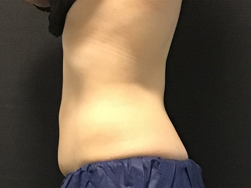 CoolSculpting Before & After Image