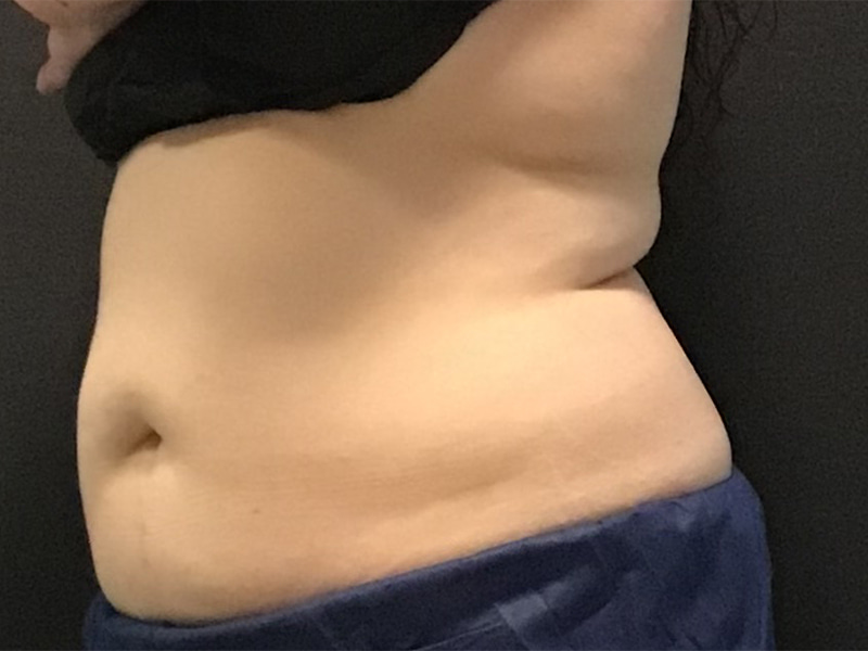CoolSculpting Before & After Image