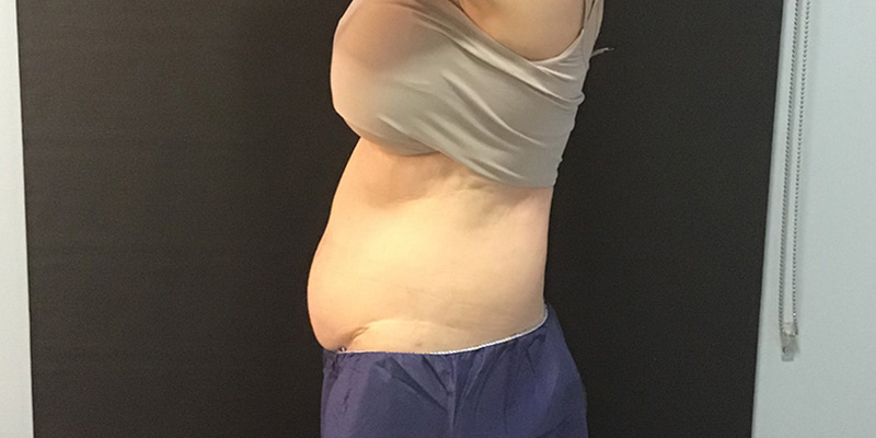 CoolSculpting Before & After Image