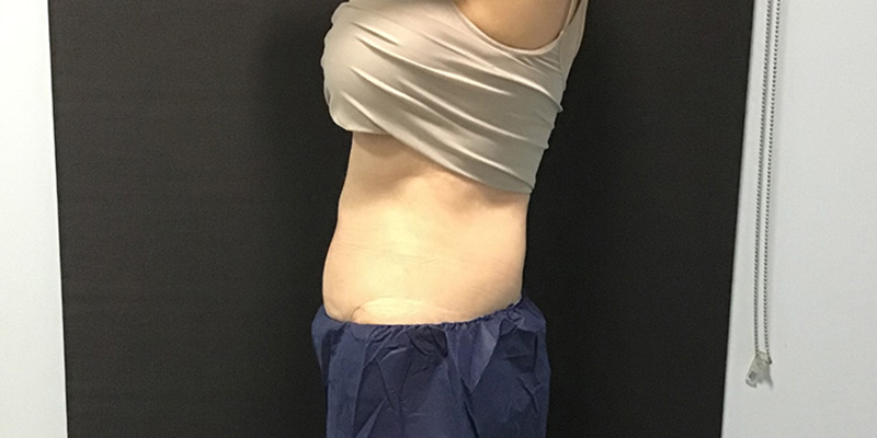 CoolSculpting Before & After Image