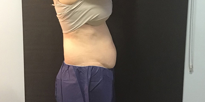 CoolSculpting Before & After Image