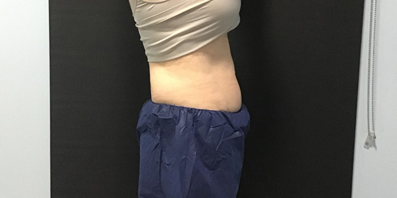 CoolSculpting Before & After Image