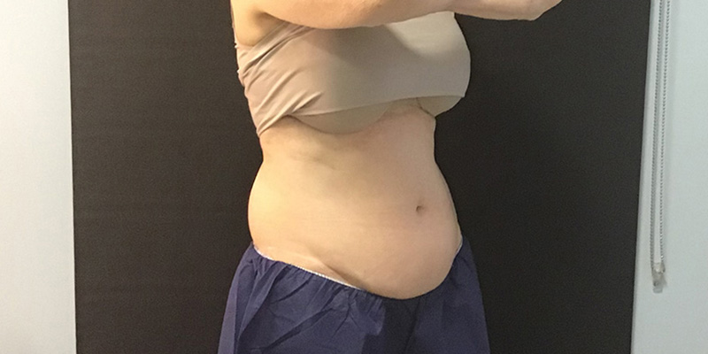 CoolSculpting Before & After Image