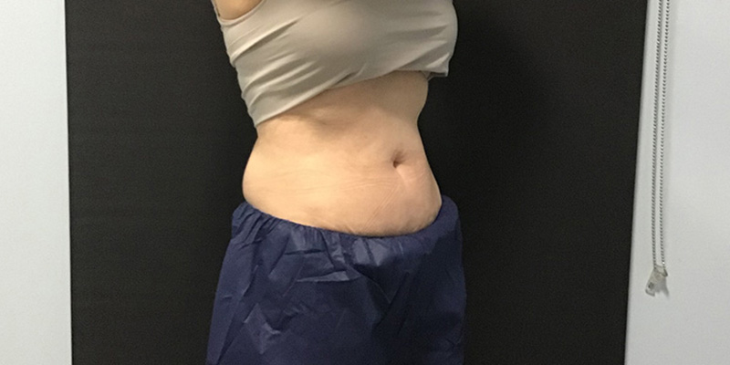 CoolSculpting Before & After Image