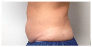 CoolSculpting Before & After Image