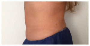 CoolSculpting Before & After Image