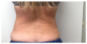 CoolSculpting Before & After Image
