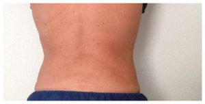 CoolSculpting Before & After Image