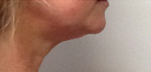CoolSculpting Before & After Image