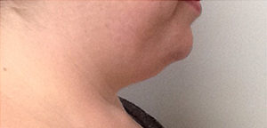 Coolsculpting before after photos Before & After Image