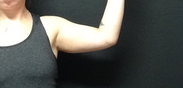 CoolSculpting Before & After Image