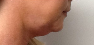 CoolSculpting Before & After Image