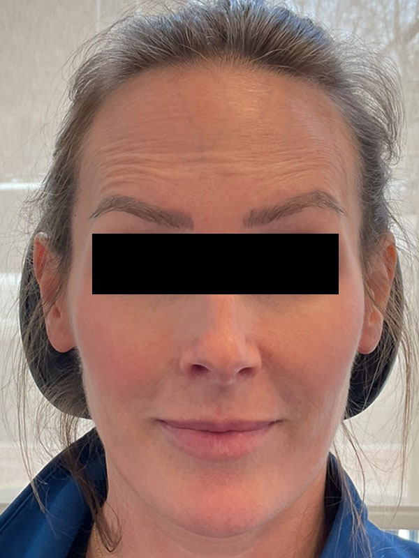 Botox Before & After Image