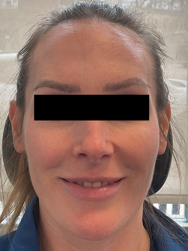 Botox Before & After Image