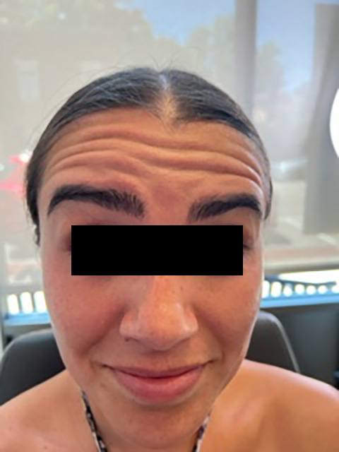 Botox Before & After Image