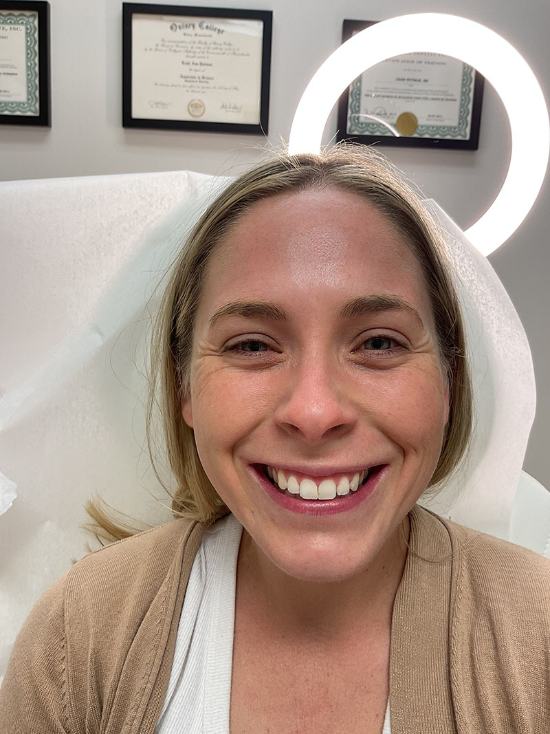 Botox Before & After Image