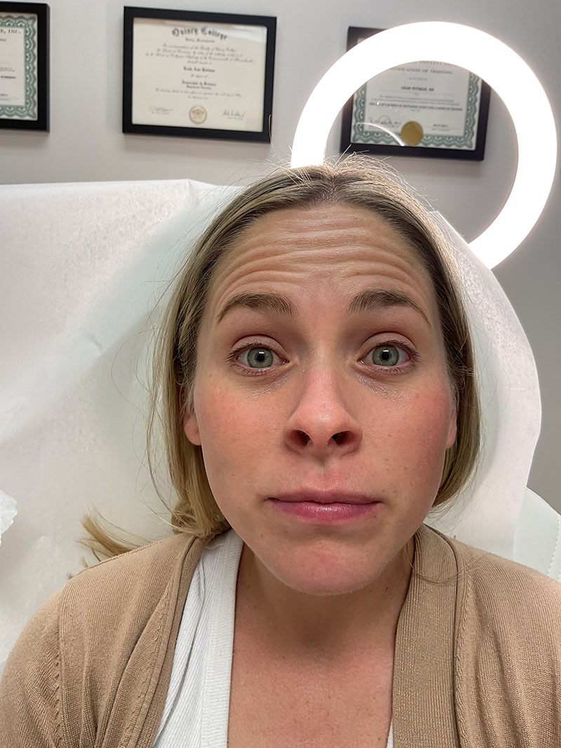 Botox Before & After Image