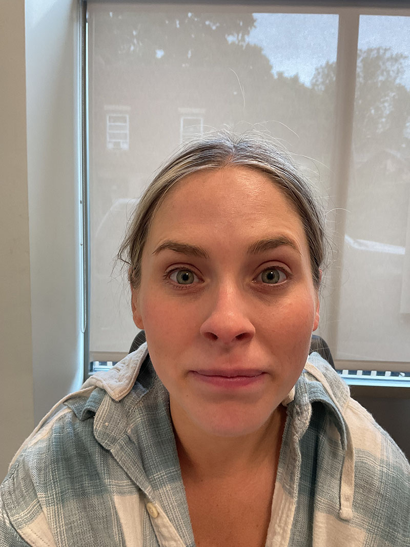 Botox Before & After Image