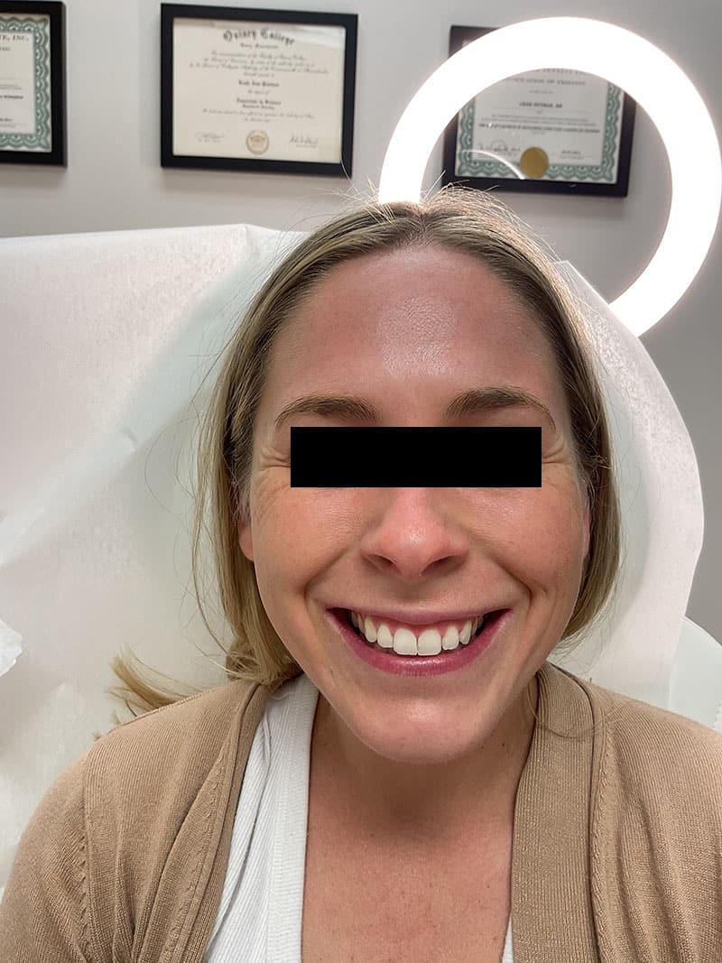 Botox before after photos Before & After Image