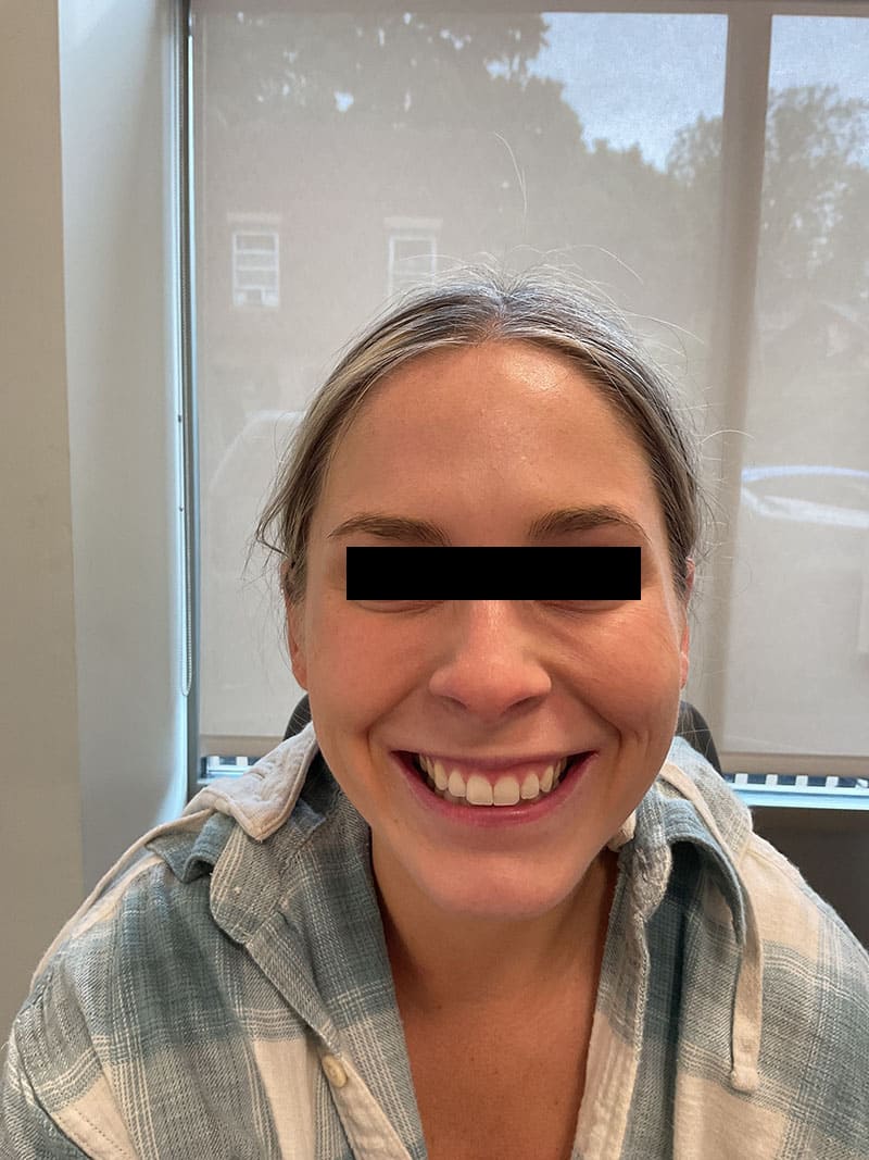 Botox before after photos Before & After Image