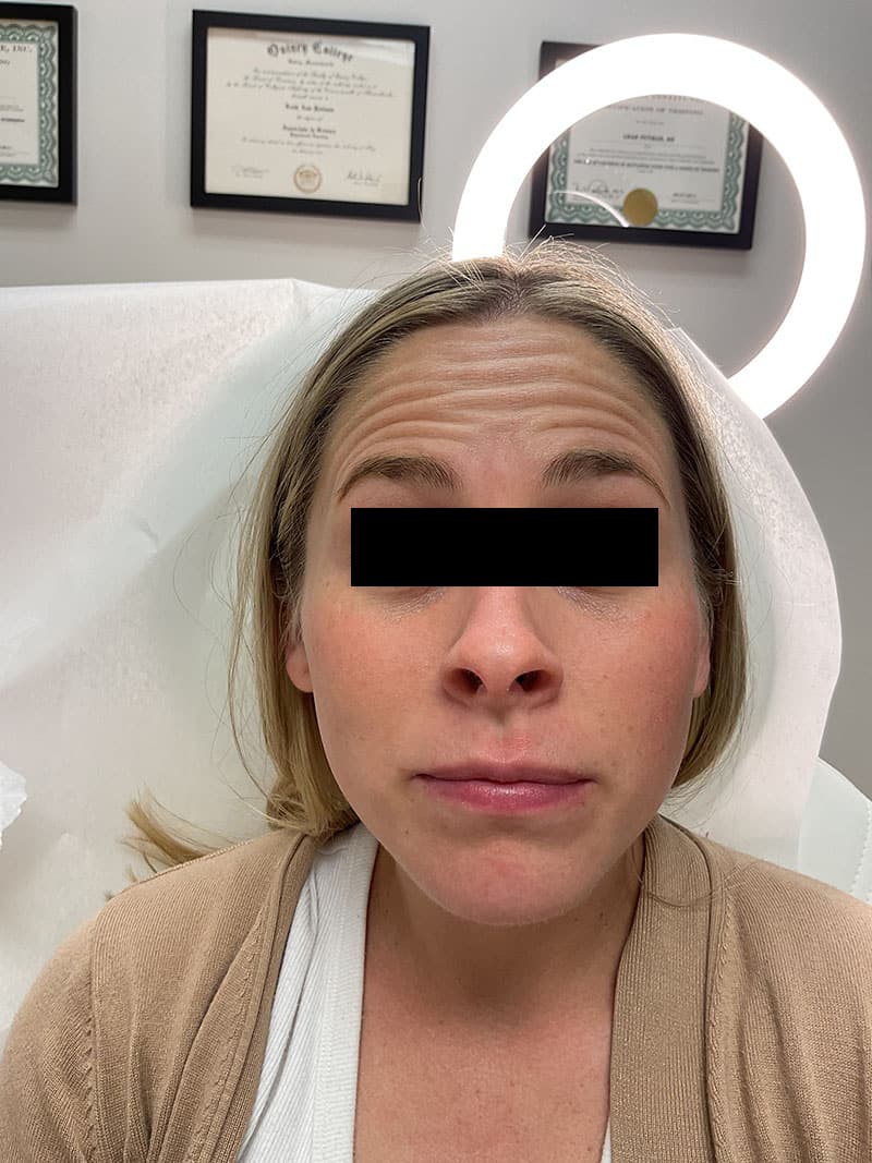 Botox before after photos Before & After Image