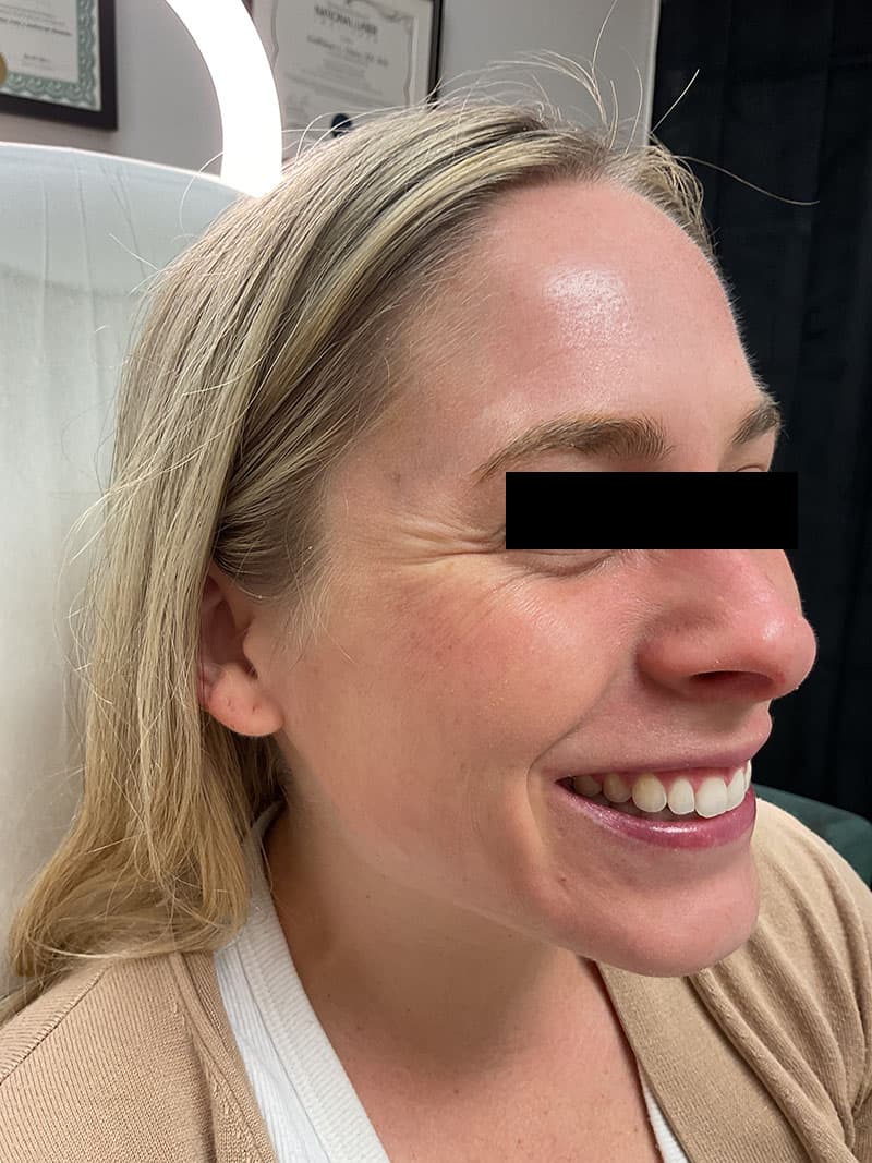 Botox Before & After Image