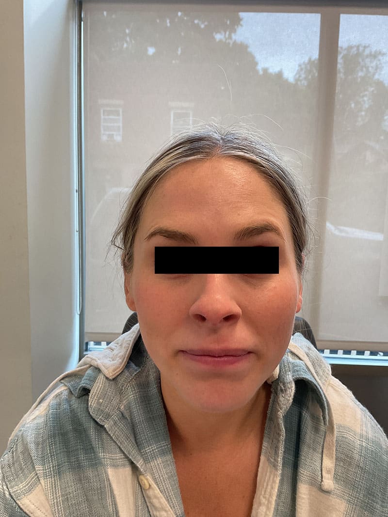 Botox before after photos Before & After Image