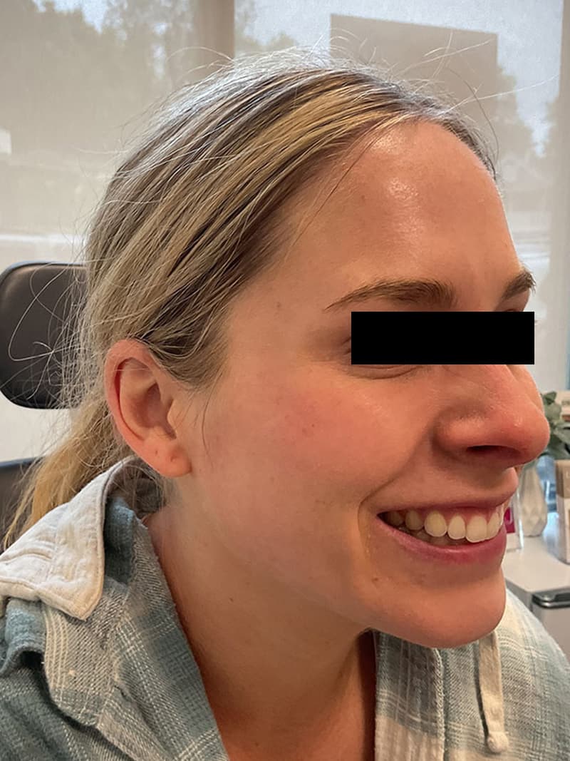 Botox Before & After Image