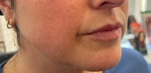 Juvederm Ultra Before & After Image