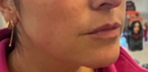 Juvederm Ultra Before & After Image