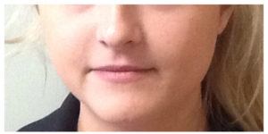 Juvederm Ultra Before & After Image