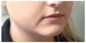 Juvederm Ultra Before & After Image