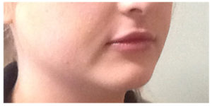 Juvederm Ultra Before & After Image