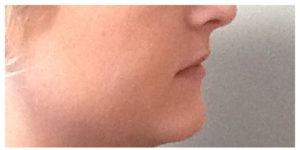 Juvederm Ultra Before & After Image