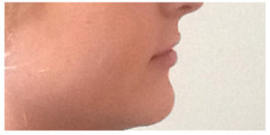 Juvederm Ultra Before & After Image