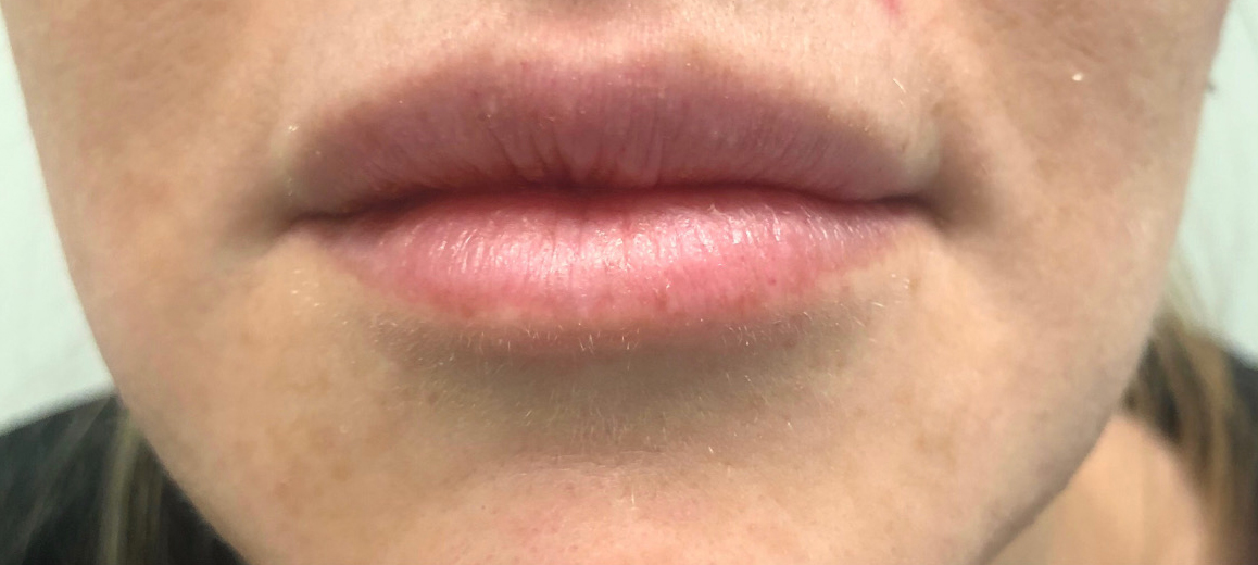 Juvederm Ultra Before & After Image